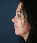 Feel Beautiful - Rhinoplasty SD 227 - After Photo